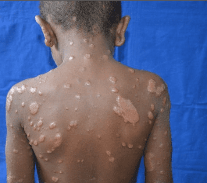 Leprosy-in-Jamaica